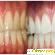 Отбеливание зубов White Light - Отбеливание зубов - Фото 69490